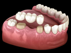 Dental Implants Melbourne