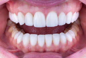 Affordable Dentures results sunshine coast