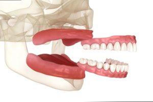 How To Tell If Your Dentures Are Too Big full