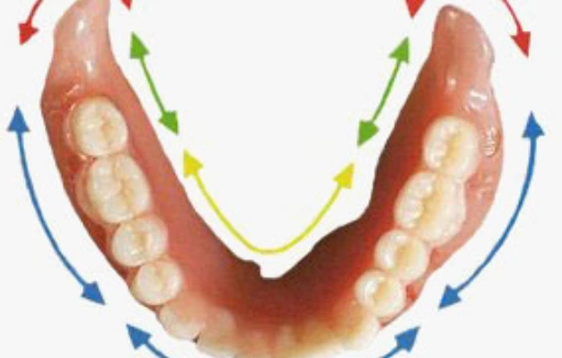 lower-suction-denture-illustration Illustration of a lower suction denture showing retention and stability with directional arrows.